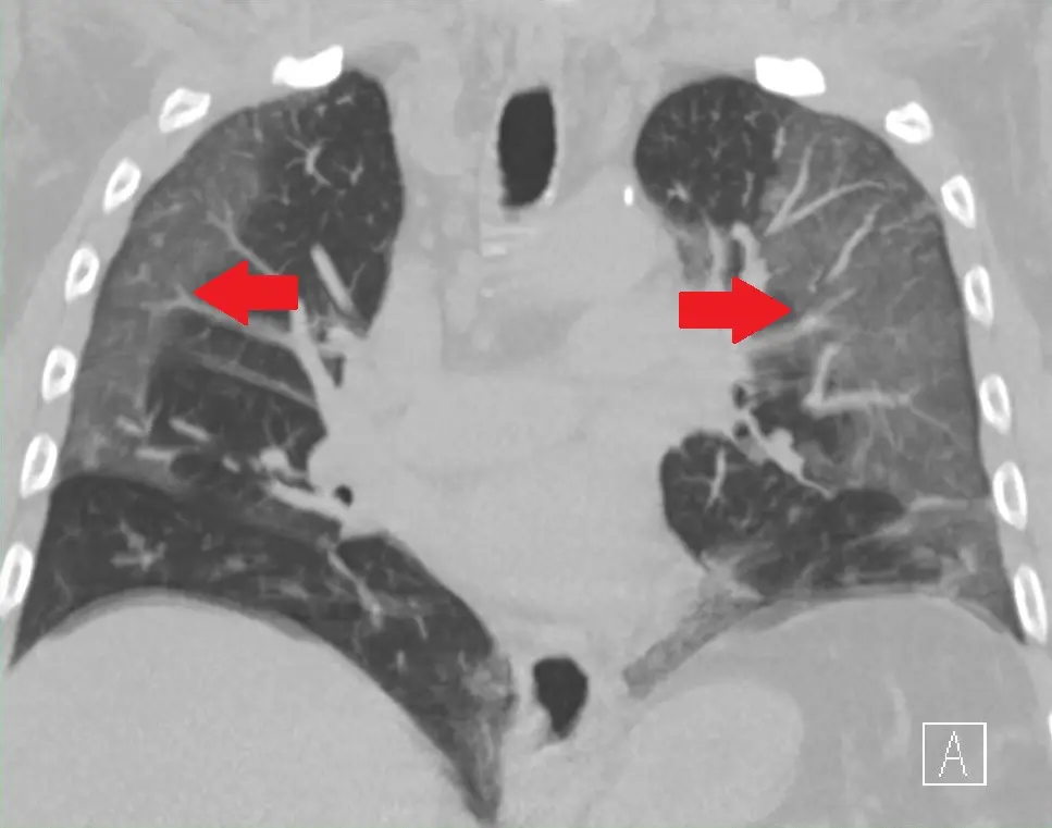 Ground Glass Opacities in HRCT Lung